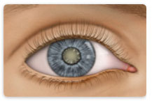 Learn about Cataract at New Westminster Optometry Clinic