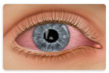 Learn about Conjunctivitis at New Westminster Optometry Clinic