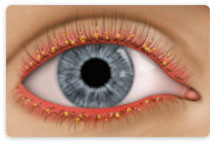 Learn about Blepharitis at New Westminster Optometry Clinic